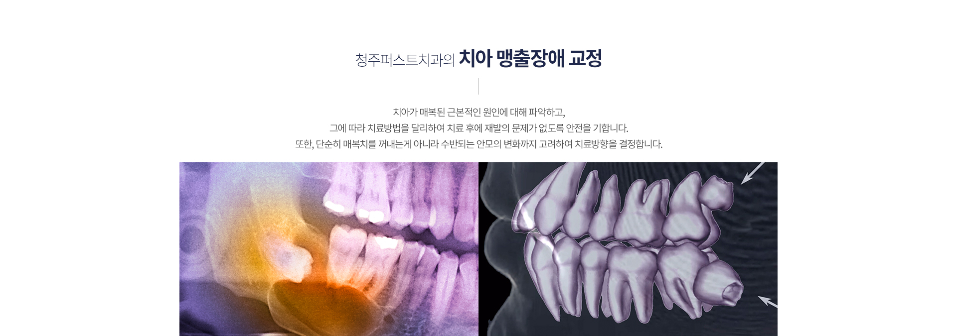 치아 맹출장애